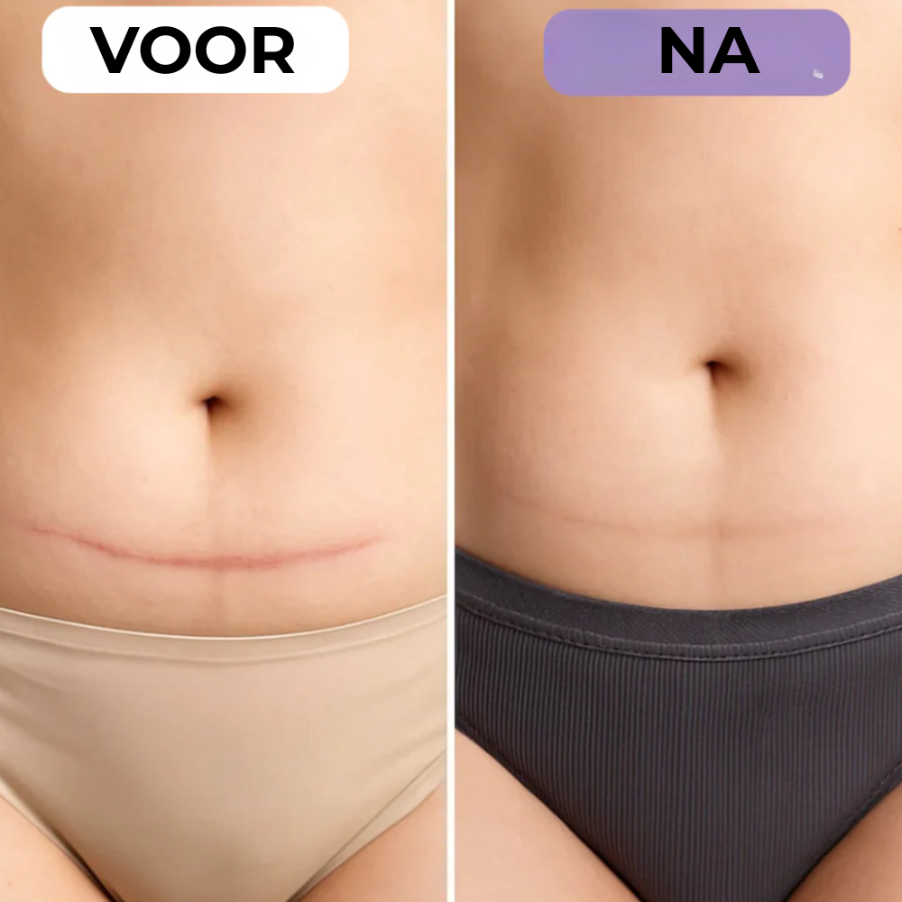 NovaSkin - Siliconenpleisters tegen littekens en rimpels