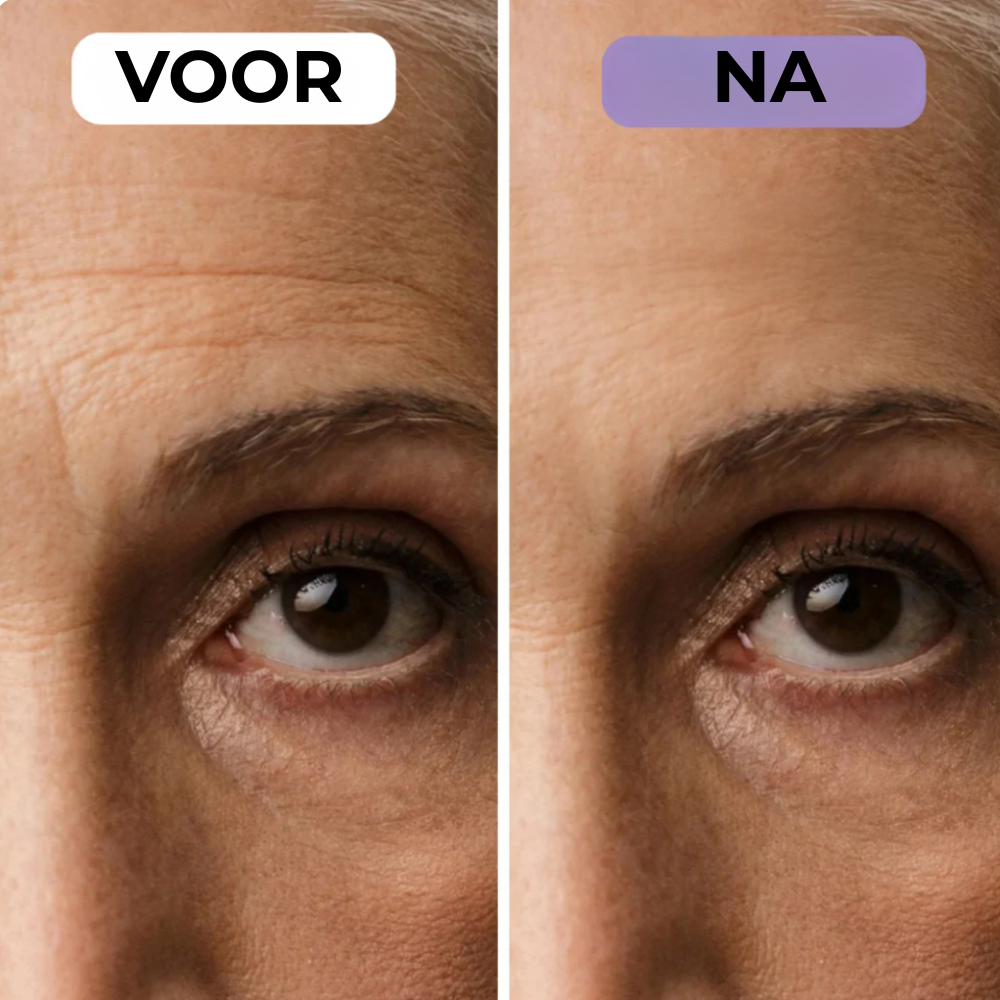 NovaSkin - Siliconenpleisters tegen littekens en rimpels