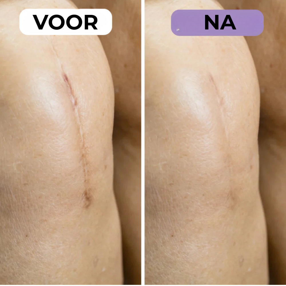 NovaSkin - Siliconenpleisters tegen littekens en rimpels