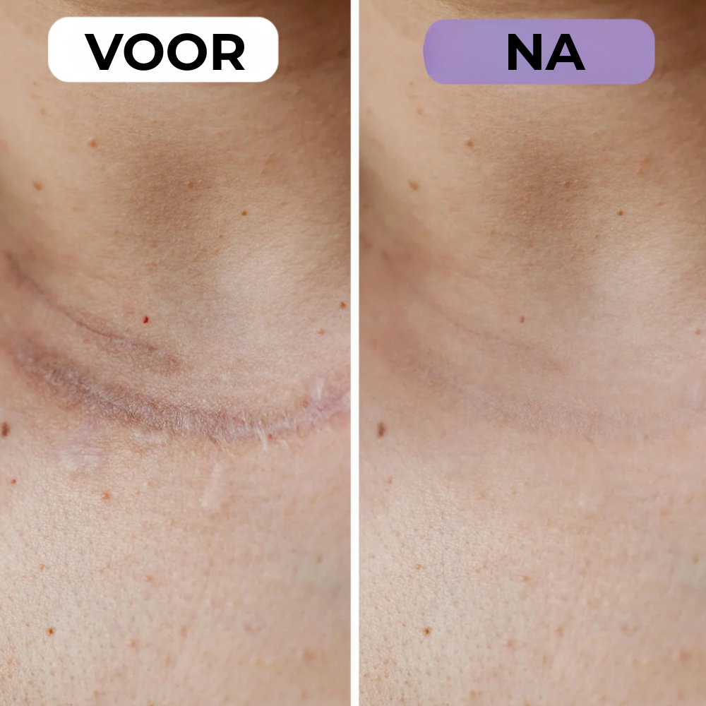 NovaSkin - Siliconenpleisters tegen littekens en rimpels