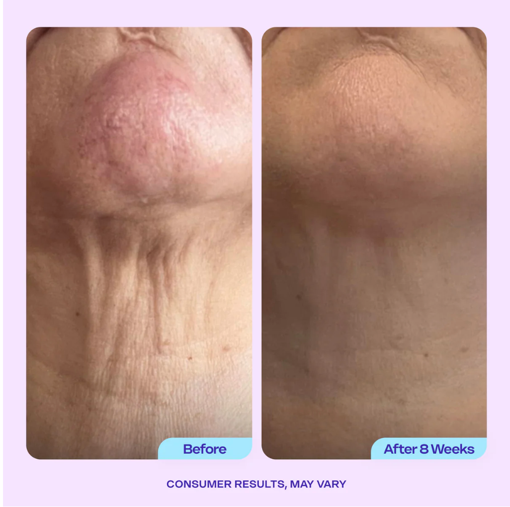 Bloom Nekverjongende Crème