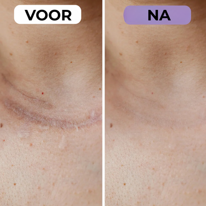 NovaSkin - Siliconenpleisters tegen littekens en rimpels